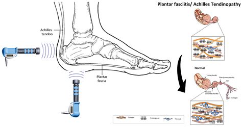 Shockwave Therapy For Shin Splints Ankle Foot And Orthotic Centre