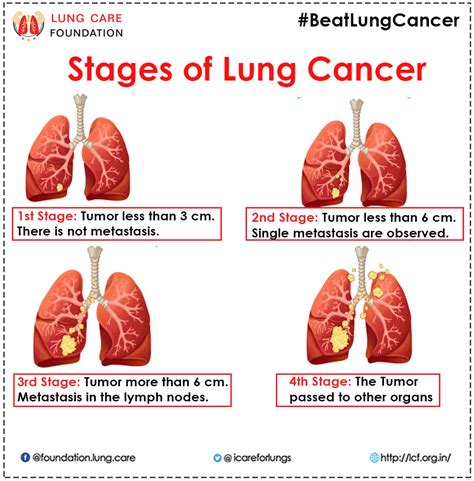 stage 2 of lung cancer