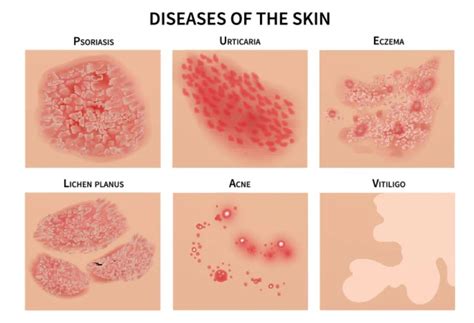 Skin Infections Skin And Hair Laser Clinic In Gurugram
