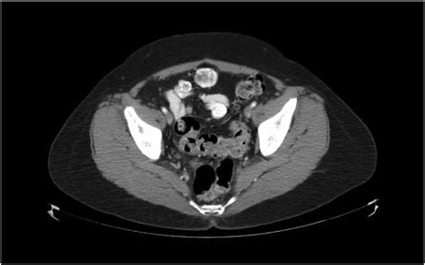 Initial Ct Pelvis With Contrast Showing Multiple Enlarged Peritoneal