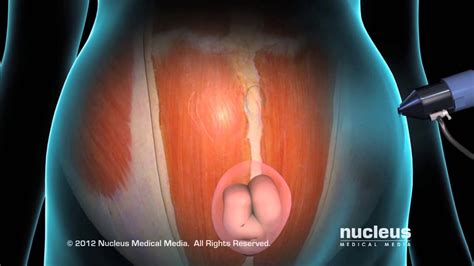 Ventral Incisional Hernia Youtube