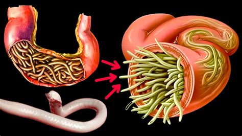 The Best Herbs For Parasites 🔥 How To Get Rid Of Tapeworms 🔥 How To Get Rid Of Worms In Humans