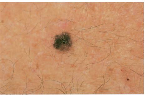 Skin Cancer Moles On Arm Idaman