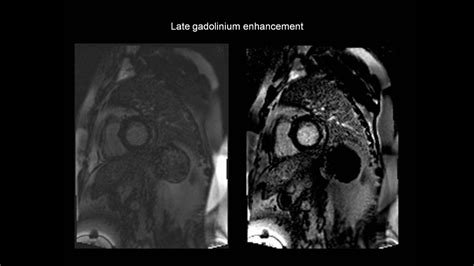 Cardiac mri is particularly useful because the iron overload directly affects magnetic resonance imaging classified as idiopathic, these cases are attributed to genetic factors, viral myocarditis. How to assess myocarditis with the help of cardiac MRI ...