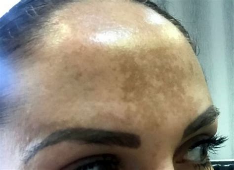 Woman Who Spent £4000 Trying To Repair Sun Damaged Skin Finally Cures