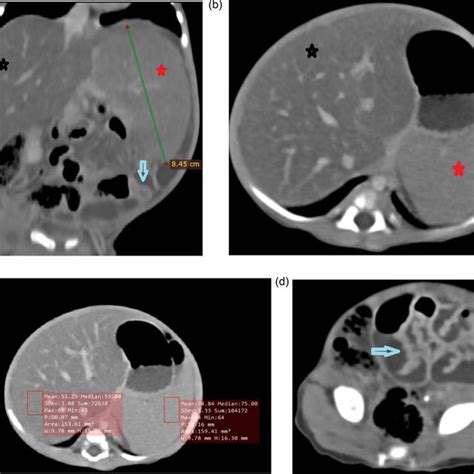 Selected Axial And Coronal Contrast Enhanced Abdomen Ct Scan Images