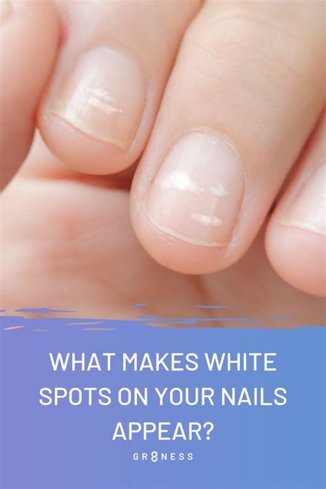 Here S What It Means If You Have White Spots On Your Nails The Healthy