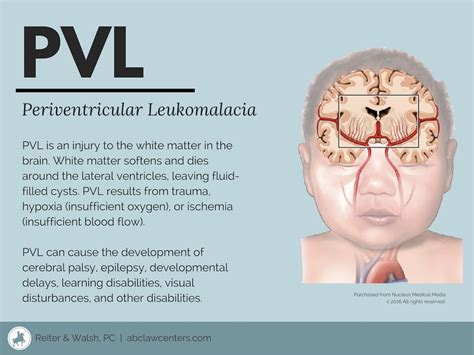 Periventricular Leukomalacia Ultrasound