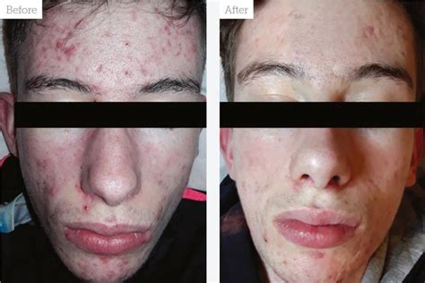 Treating Acne And Scarring Aesthetics