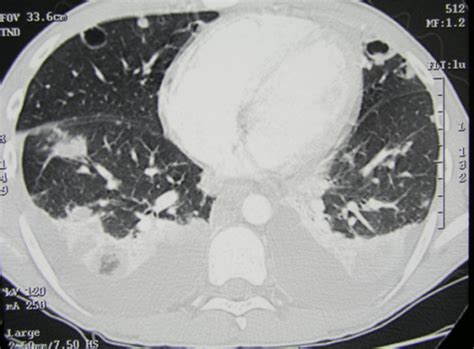 Chest Ct Of A Patient With Necrotizing Pneumonia Caused Open I