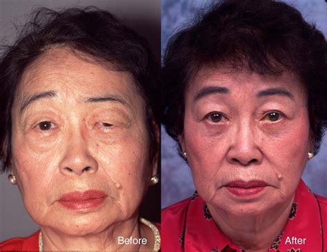 Asian Eyelid Surgery Example 6 L Steinsapir Kenneth