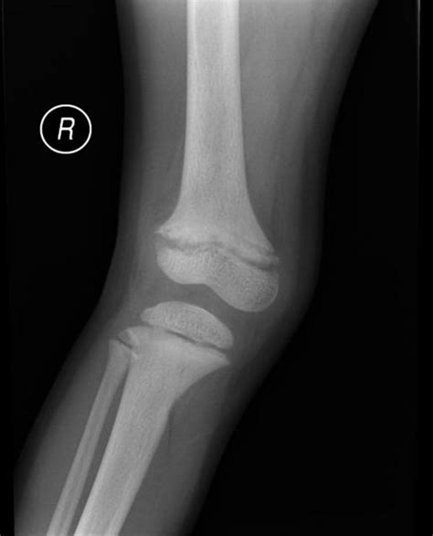 Rickets Other Imaging Findings Wikidoc