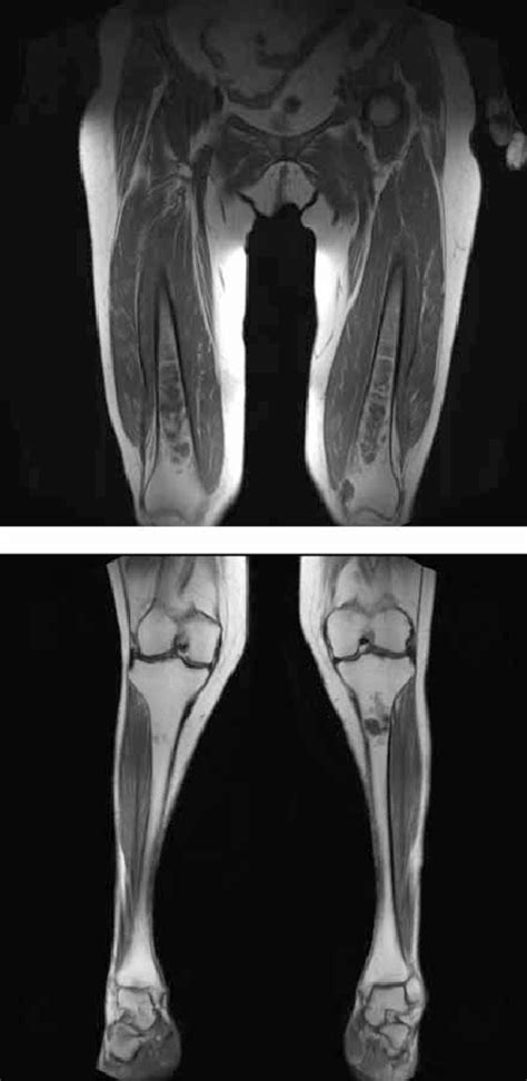 Magnetic Resonance Imaging Mri Findings Of Bone Involvement