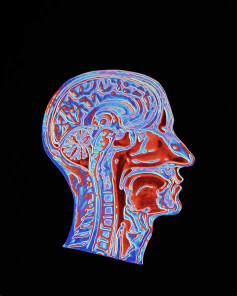 Coloured Ct Scan Of A Head Showing A Healthy Brain By Pasieka