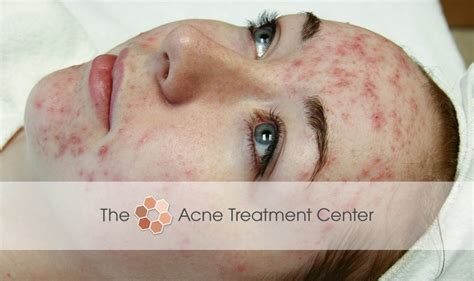 Non Inflamed Acne Treatment Photo Acne Treatment Center Portland Or