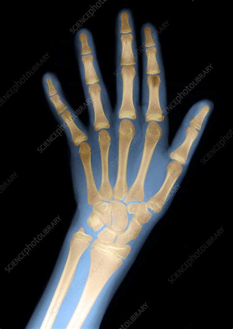 Childs Hand X Ray Stock Image M4150625 Science Photo Library