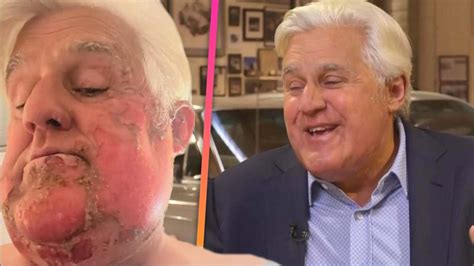 Jay Leno S Harsh Motorcycle Accident Know It All