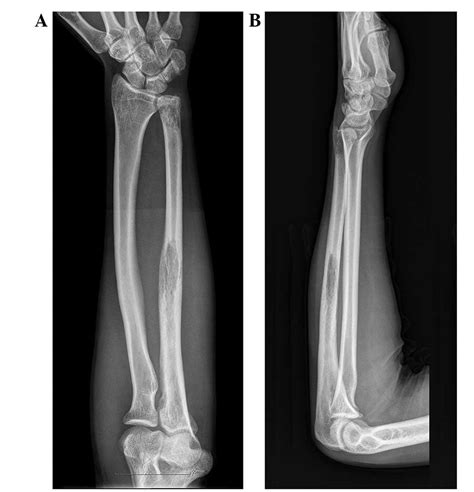 Ewings Sarcoma Of The Ulna Treated With Sub Total Resection And