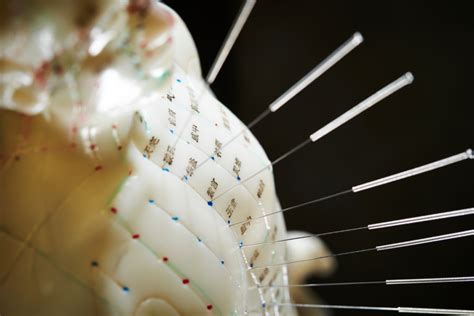 Acupuncture The Top 5 Reasons To Try Acupuncture Therapy