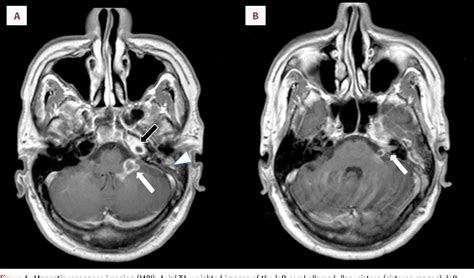 Figure 1 From Gradenigos Syndrome In A Patient With Chronic