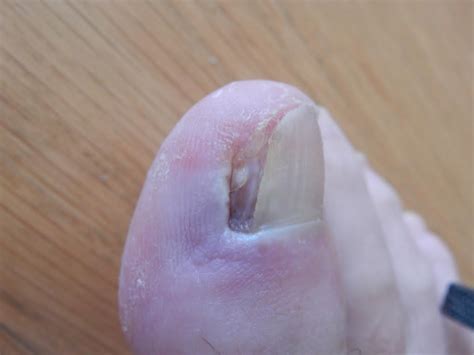 Foot And Ankle Problems By Dr Richard Blake Chronic Ingrown Toenail Email Correspondance Post