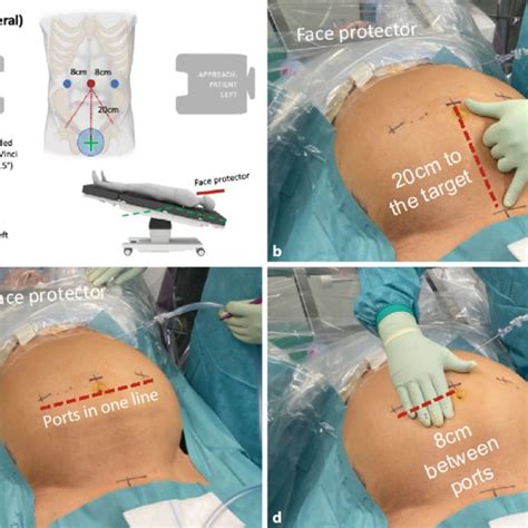 Surgical Steps Of Robotic Inguinal Hernia Repair R TAPP A Opening
