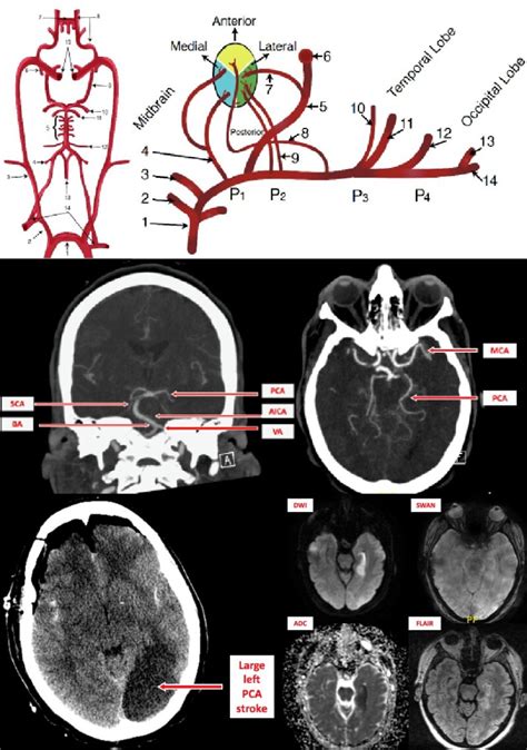 Posterior Cerebral Artery Stroke Statpearls Ncbi Bookshelf