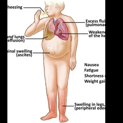Pulmonary Edema Signs And Symptoms
