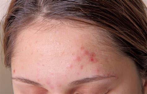 How To Get Rid Of Acne And Scars Dr Health Clinic Homepage