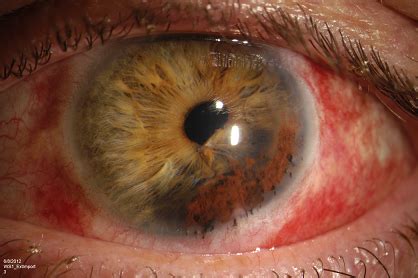 As mentioned, the various forms of black spots result from the various causes. Cornea Tattoo