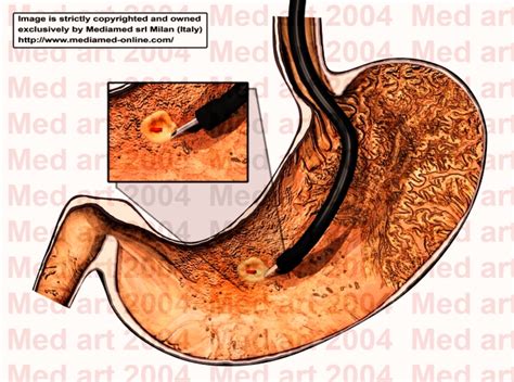 Stomach Ulcers Anatomy System Human Body Anatomy Diagram And Chart Images