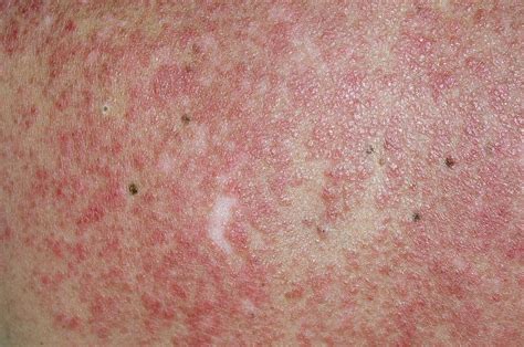 Lupus Rash Photograph By Dr P Marazzi Science Photo Library Gambaran