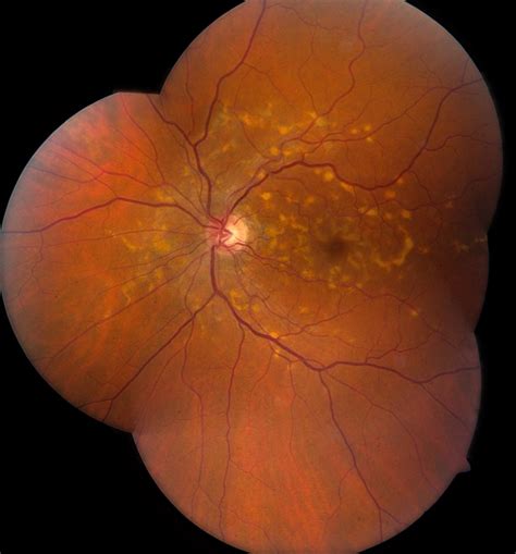 Stargardt Disease Retina Image Bank