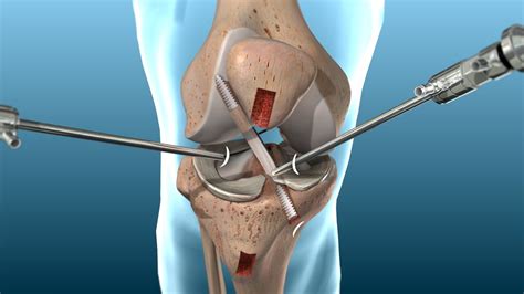Acl And Pcl Knee Repair Or Reconstructive Surgery Free Consultation