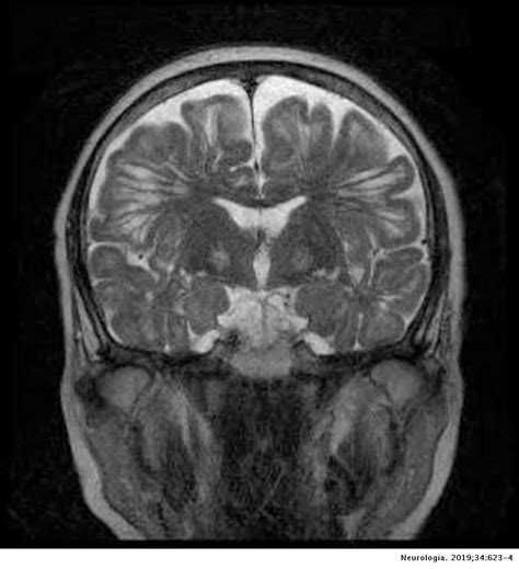 Relationship Between Virchowrobin Spaces And Alzheimer Disease A Case