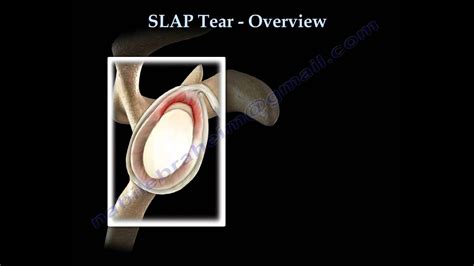 Slap Tear Overview Everything You Need To Know Dr Nabil Ebraheim