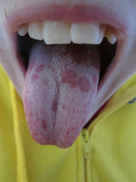Weird Patches And Bumps On Tongue Help Please Yahoo Answers
