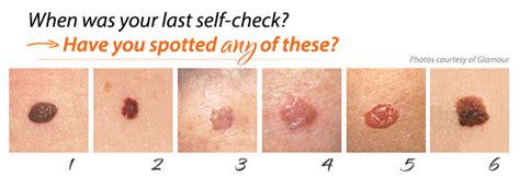 What Skin Cancer Can Look Like Do You Know How To Ide