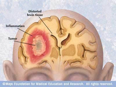 These diseases may cause young cats to develop tumors, particularly in the case of felv, which can hide out in the neurologic system or bone marrow, making routine tests come back negative even when a cat is infected. Brain Tumors: Who's Had Them, What The Symptoms Are, And ...