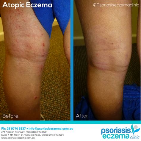 Atopic Eczema Before And After Results At The Psoriasis Eczema Clinic