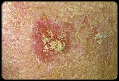 The general warning signs of skin cancer include: 43 best Melanoma and Non-Melanoma Skin Cancers images on ...