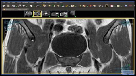 Hip Avulsion Fracture of the Anterior Inferior Iliac Spine ...