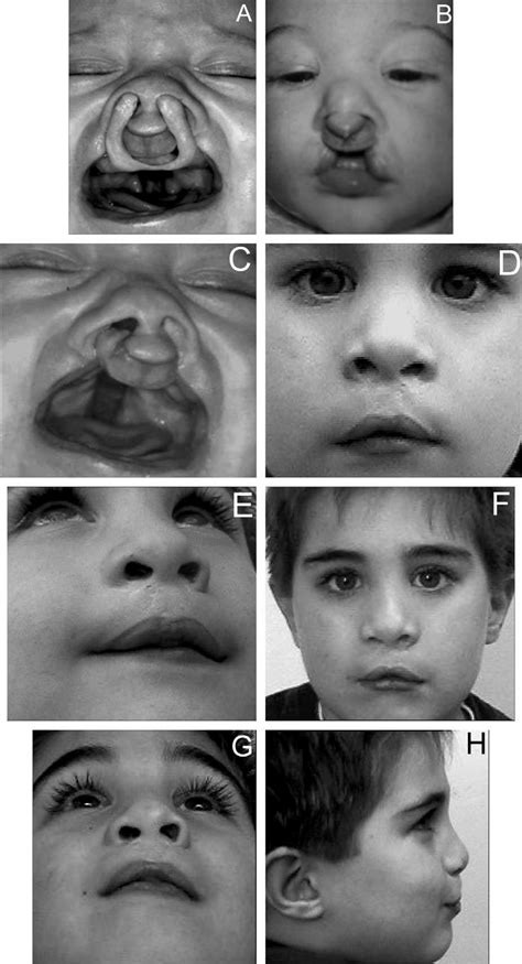 Patient With Complete Bilateral Cleft Lip And Palate A Undergoing