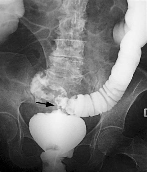 Fistulas Of The Genitourinary Tract A Radiologic Review Radiographics