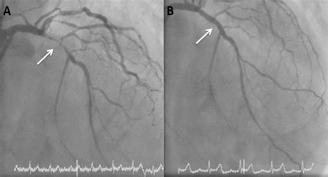 Acute Coronary Syndromes Rcp Journals