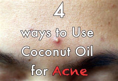 coconut oil  acne  acids  fight acne