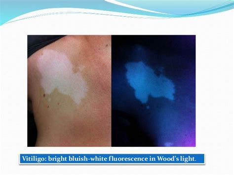 Woods Light In Dermatology