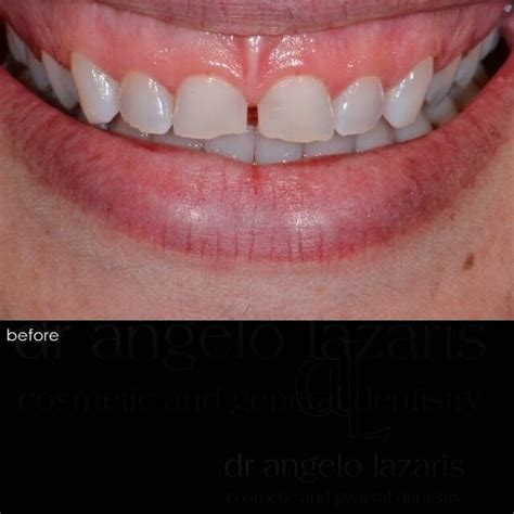 Composite Veneers Dental Veneers Smile Design Perfect Smile