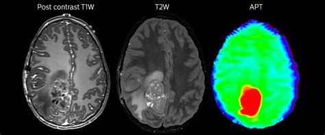 Enhancing Brain Tumor Mri With Apt Weighted Imaging Fieldstrength