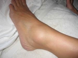 Visually, the tumor is easy to diagnose at home by a significant swelling in the affected limb. Homeopathic Treatment For Ankle Sprain - Homemade Ftempo